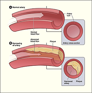 An illustration of an artery (hollow tube) that is clean, with a large cross section and normal blood flow rate. Below is another artery (hollow tube) that has plaque build up, showing that the plaque causes a narrowing of the cross section and thus increases the blood flow.